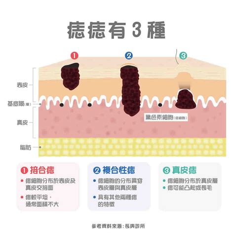 痣太多|痣變大、痣多或長毛會變皮膚癌？認識痣的形成與原因